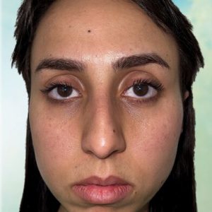 Rhinoplastie Bruxelles