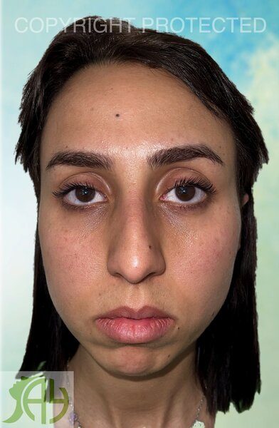 Rhinoplastie Bruxelles