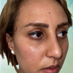 Rhinoplastie Bruxelles