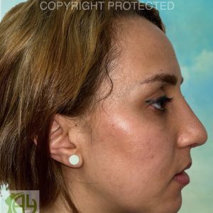 Rhinoplastie Bruxelles