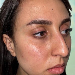 Rhinoplastie Bruxelles