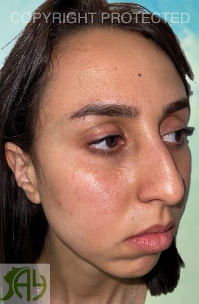 Rhinoplastie Bruxelles