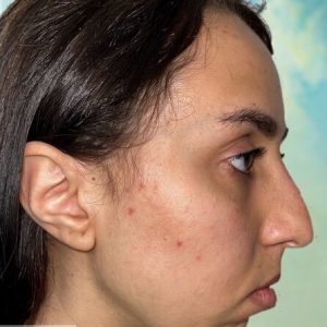 Rhinoplastie Bruxelles