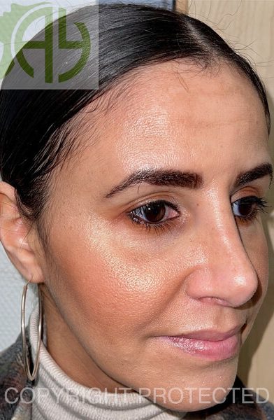 Rhinoplastie Bruxelles