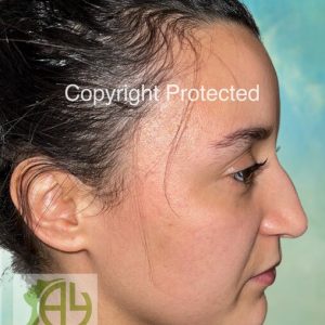 Rhinoplastie Bruxelles