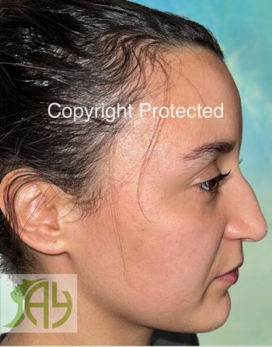 Rhinoplastie Bruxelles