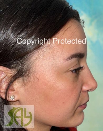 Rhinoplastie Bruxelles